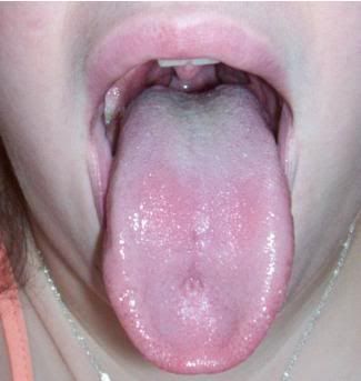 Sore Red Tongue