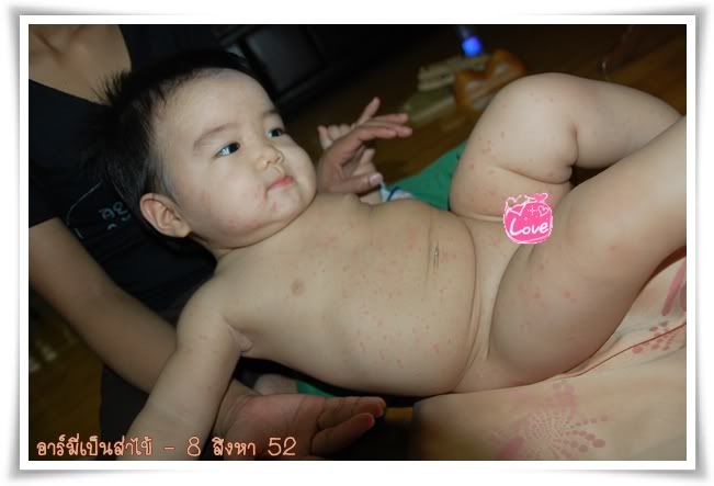 อาร์มี่เป็นตุ๊กแกน้อย ส่าไข้