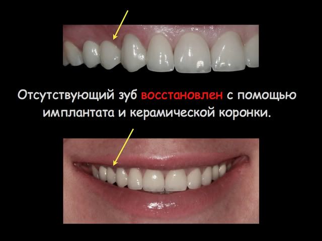 Можно ли поставить коронку на отсутствующий зуб Можно ли поставить коронку на отсутствующий зуб