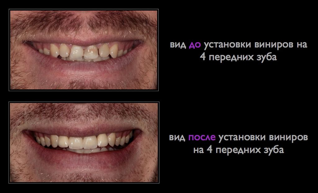 Как улучшить цвет зубов Как улучшить цвет зубов